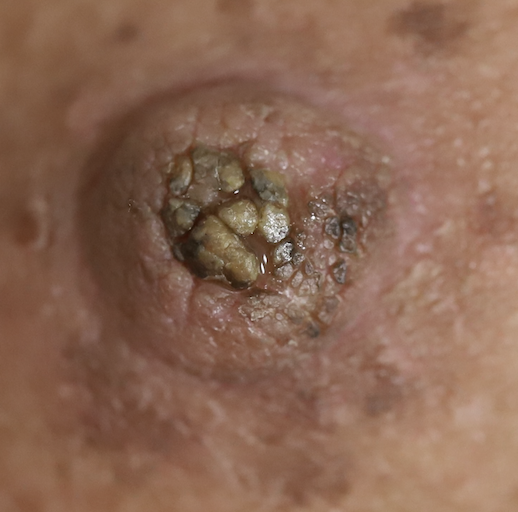 hyperkeratosis of nipple